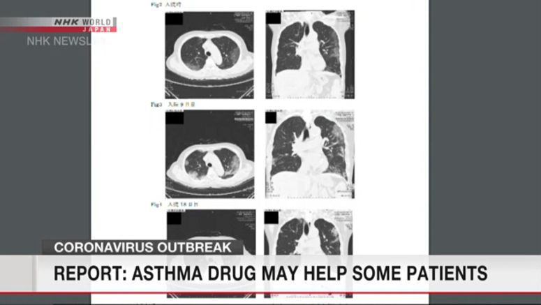 Asthma drug seems effective for COVID-19 pneumonia