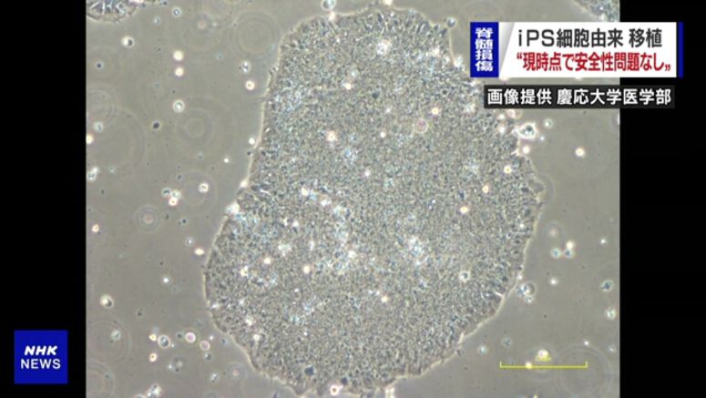 Experts okay Japanese team's use of iPS cells for spinal cord injuries