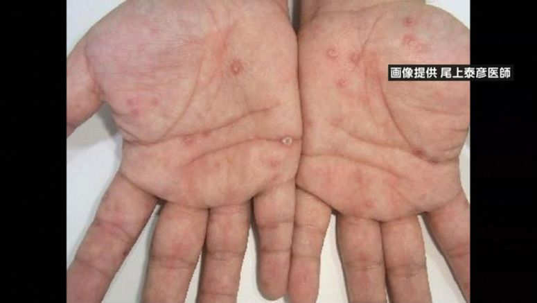 Syphilis cases hit record high in Japan