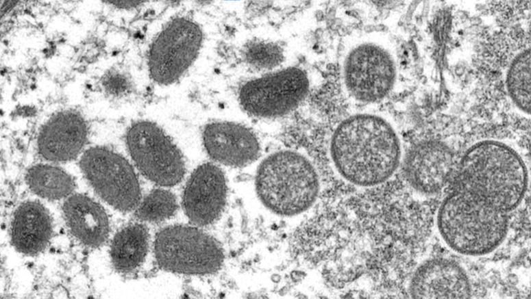 Third monkeypox case confirmed in Japan